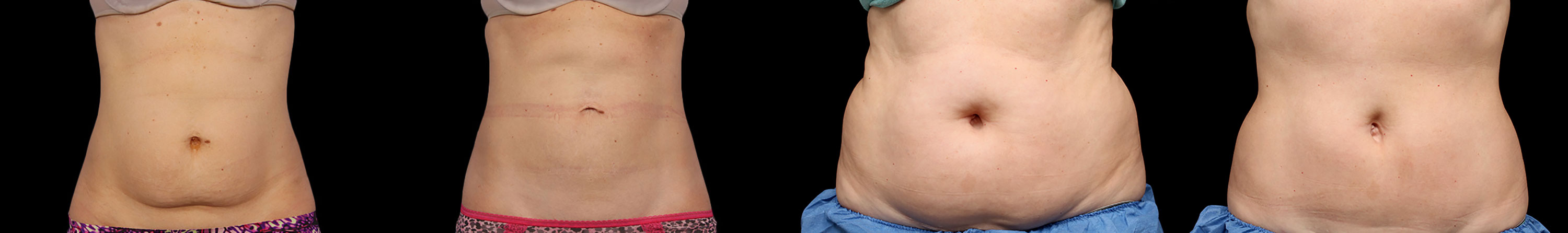 CoolSculpting Before And After Photos